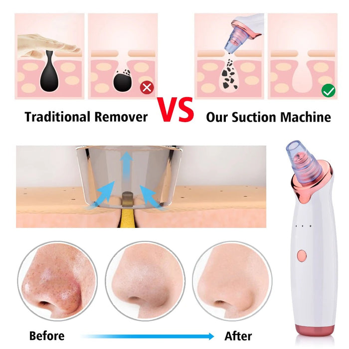 Kitchens Ware®ELECTRIC FACIAL BLACKHEAD REMOVER VACUUM